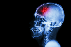 Internal Injury - X-Ray Brain
