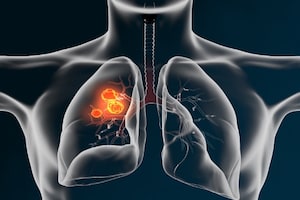 Lung Cancer