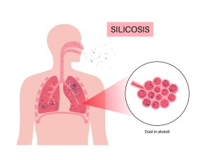 1-27-26-Silicosis-300x230