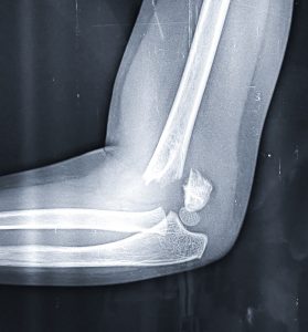 8-4-26-Common-Injuries-After-a-Car-Accident-279x300