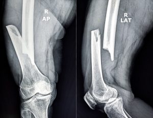 8-11-2026-Broken-Bone-Average-Settlement-300x232