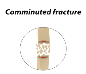 Comminuted Fracture
