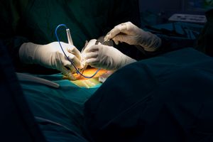 The Problem With Spinal Cord Stimulators
