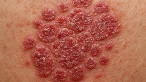 The Relationship Between Dupixent And T-Cell Lymphoma