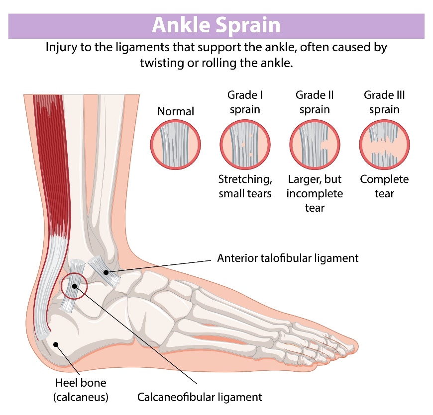 Injury to the ligaments that support the ankle