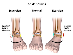 Ankle sprains
