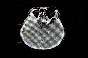 Signs of Traumatic Brain Injury