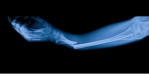 What Is The Average Settlement For A Broken Bone Injury In NY?