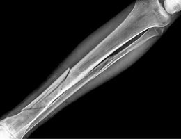 What Is The Average Settlement For A Broken Bone Injury In NY?