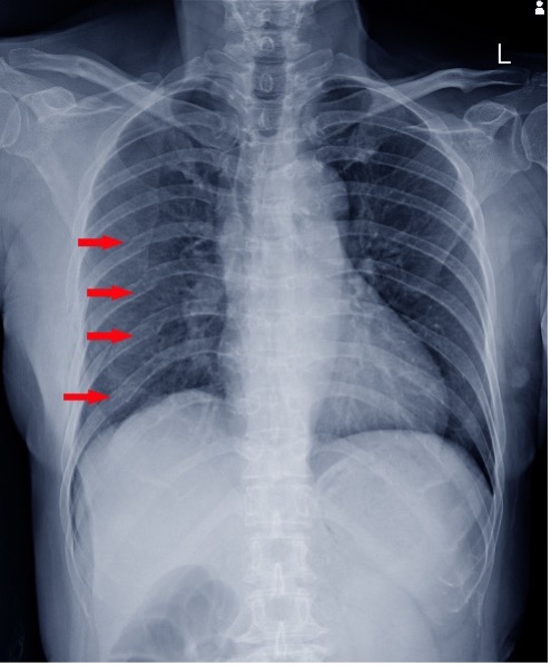Common injuries after a car accident