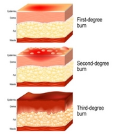 Burn injuries