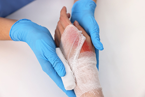 Syracuse, New York: Your Rights After A Chemical Burn Injury