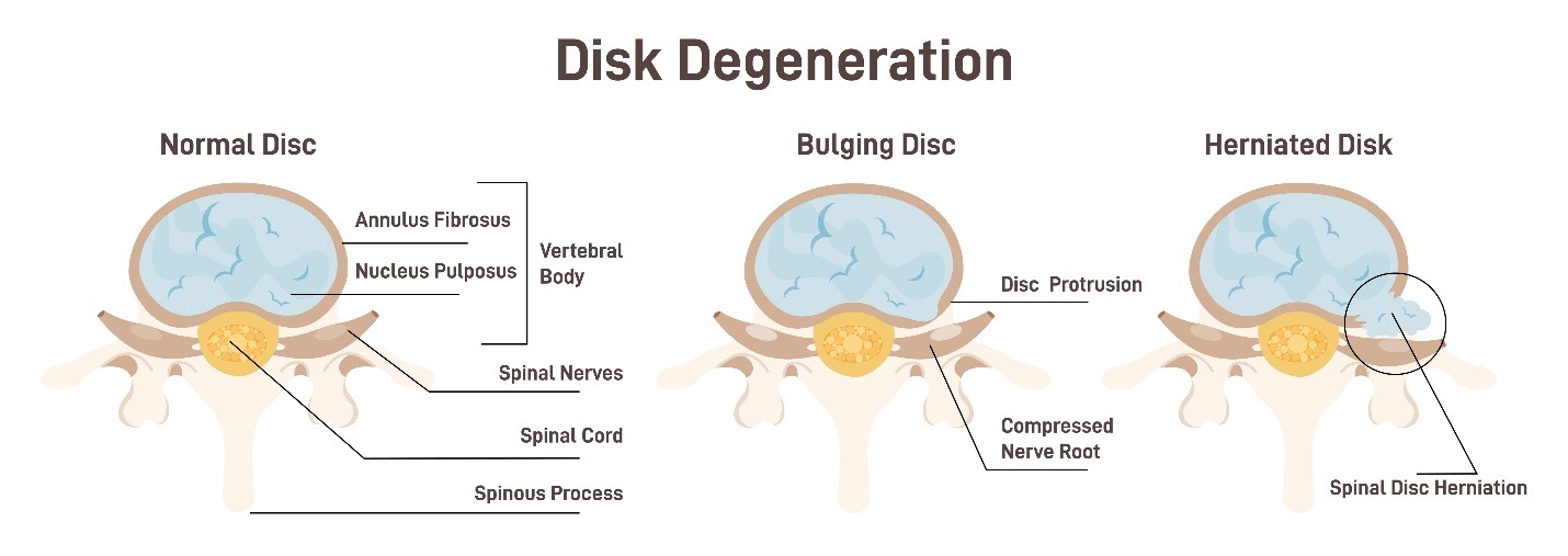 What is a herniated Disk worth