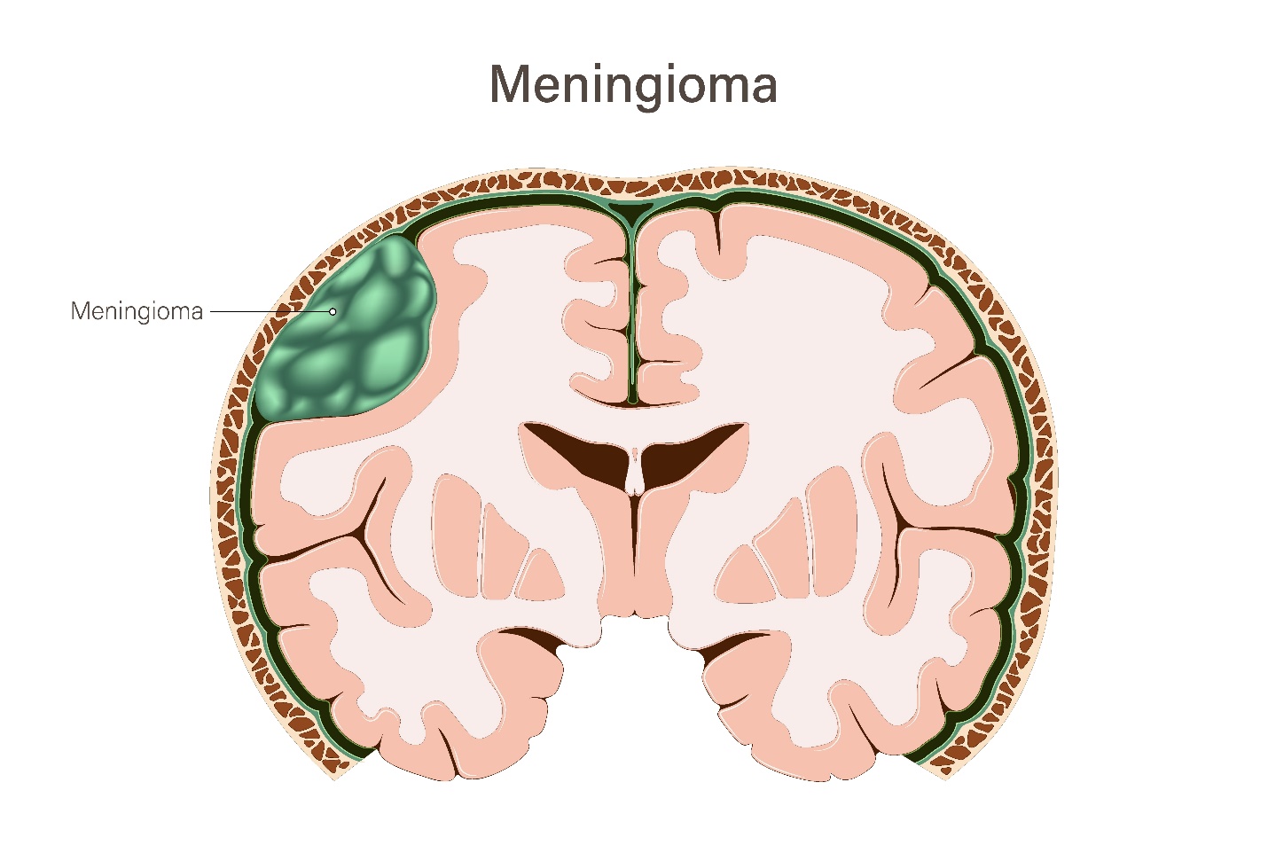 Depo-Provera And Brain Tumors