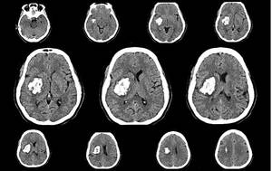 Signs of Traumatic Brain Injury