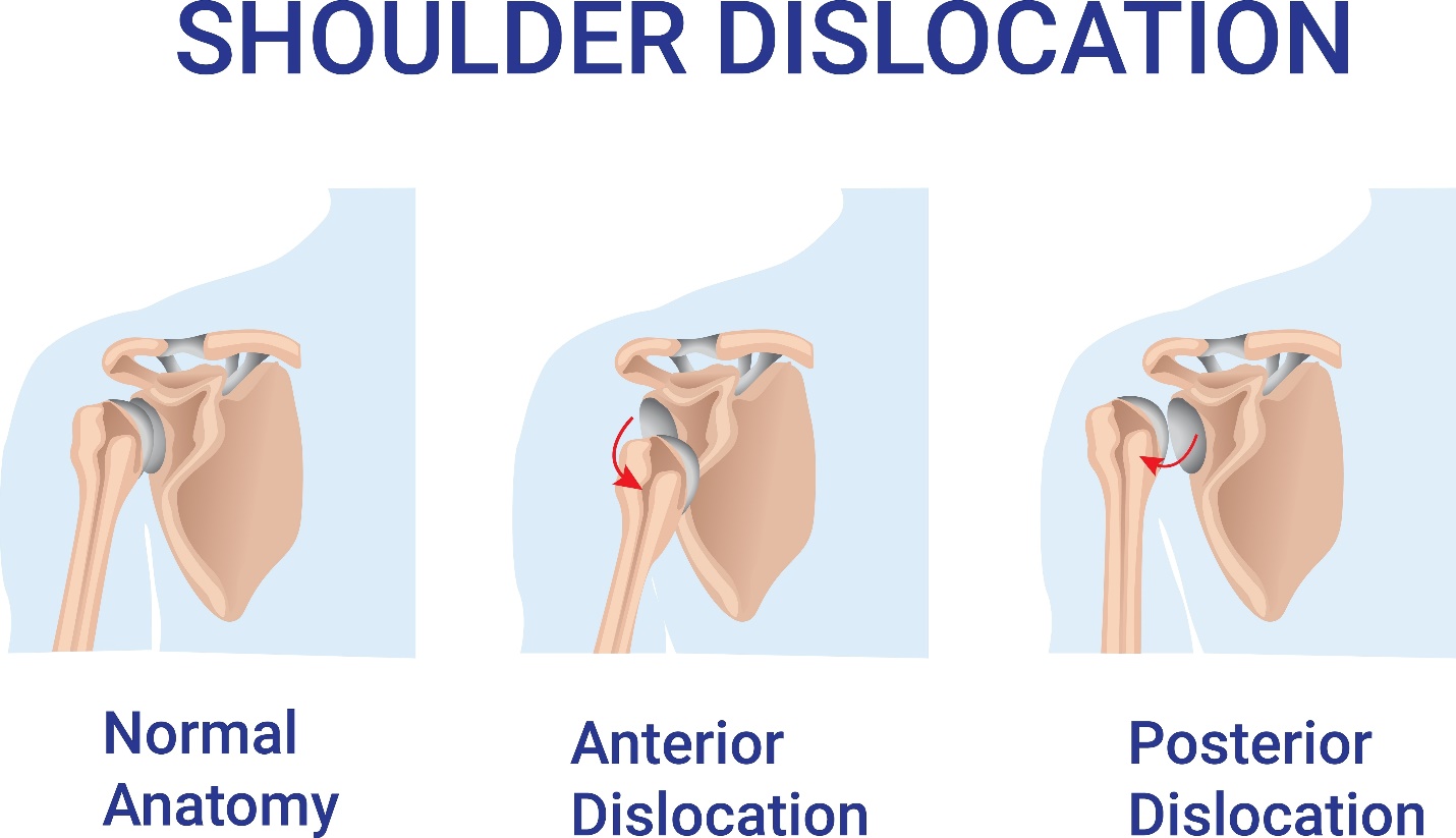 Shoulder dislocation
