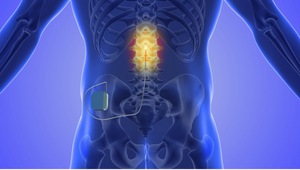 Spinal Cord Stimulator Lawsuits In Rochester, New York