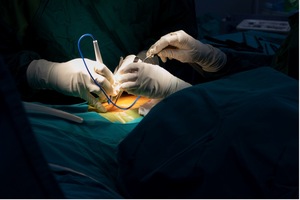 Spinal Cord Stimulator Lawsuits In Buffalo, New York