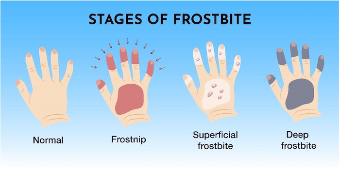 Stages of frostbite