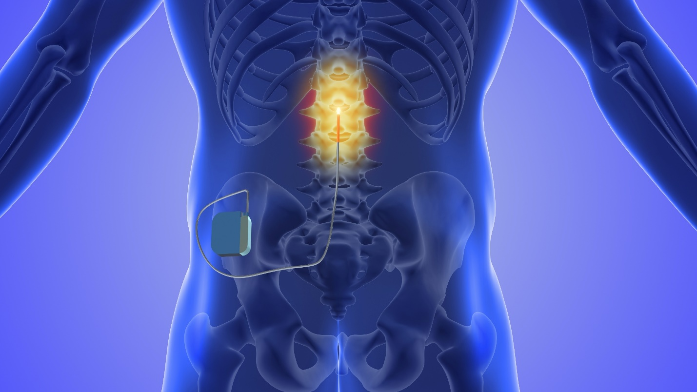 NYC SPINAL CORD STIMULATOR LAWSUITS