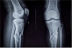 Syracuse, New York, Rollover Car Accidents