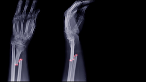Syracuse Hand Fracture