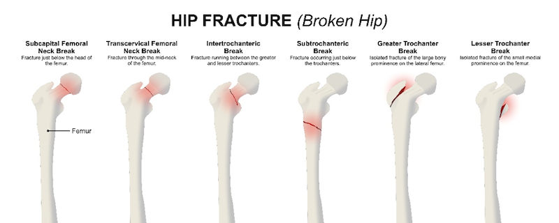 Syracuse Hip Fracture
