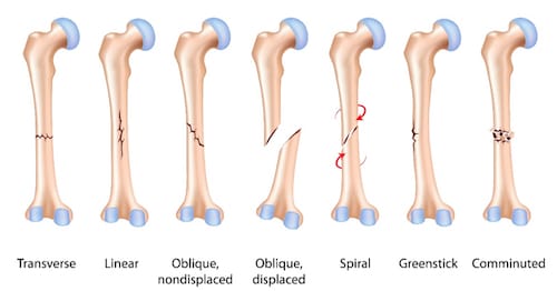 Types of broken bones