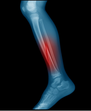 X-ray of a leg with a red highlighted